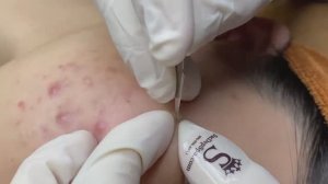 Лечение болезненных подкожных прыщей - SDS#147