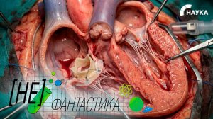 Клапан из собственных тканей. В Казахстане внедрили уникальный метод лечения порока сердца у детей