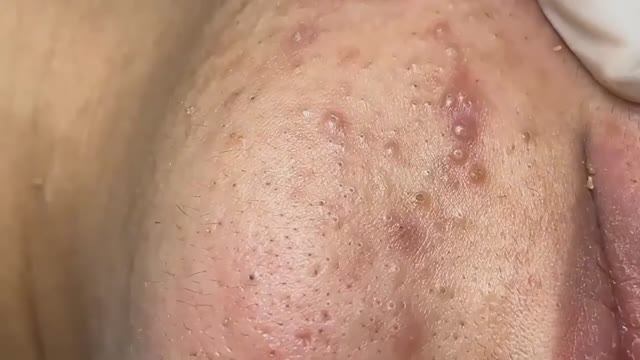 Салонная чистка лица от черных и белых комедонов #23569019 смотреть онлайн