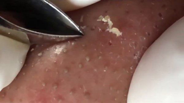 Часовая чистка лица пинцетом: удаление черных точек