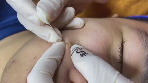 Очистка черных точек на щеках и лбу SDS#142