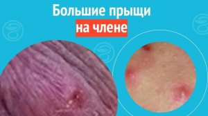😧 Большие прыщи на члене. Клинический случай №1703