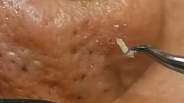 Чистка лица от угрей и акне. Выдавливание прыщей. Удаление черных точек и комедонов смотреть онлайн