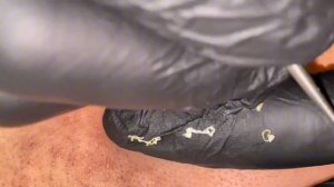 Чистка лица от угрей и акне. Выдавливание прыщей. Удаление черных точек и комедонов