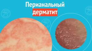 😦 Перианальный дерматит. Клинический случай №1701