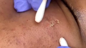 Чистка лица от угрей и акне. Выдавливание прыщей. Удаление черных точек и комедонов