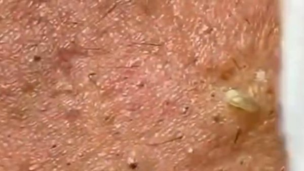 Чистка лица от угрей и акне. Выдавливание прыщей. Удаление черных точек и комедонов