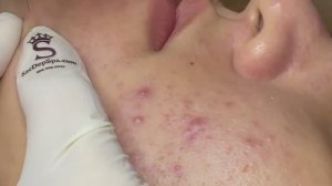 Прыщи на кожи из-за проблем с печенью - SDS#152