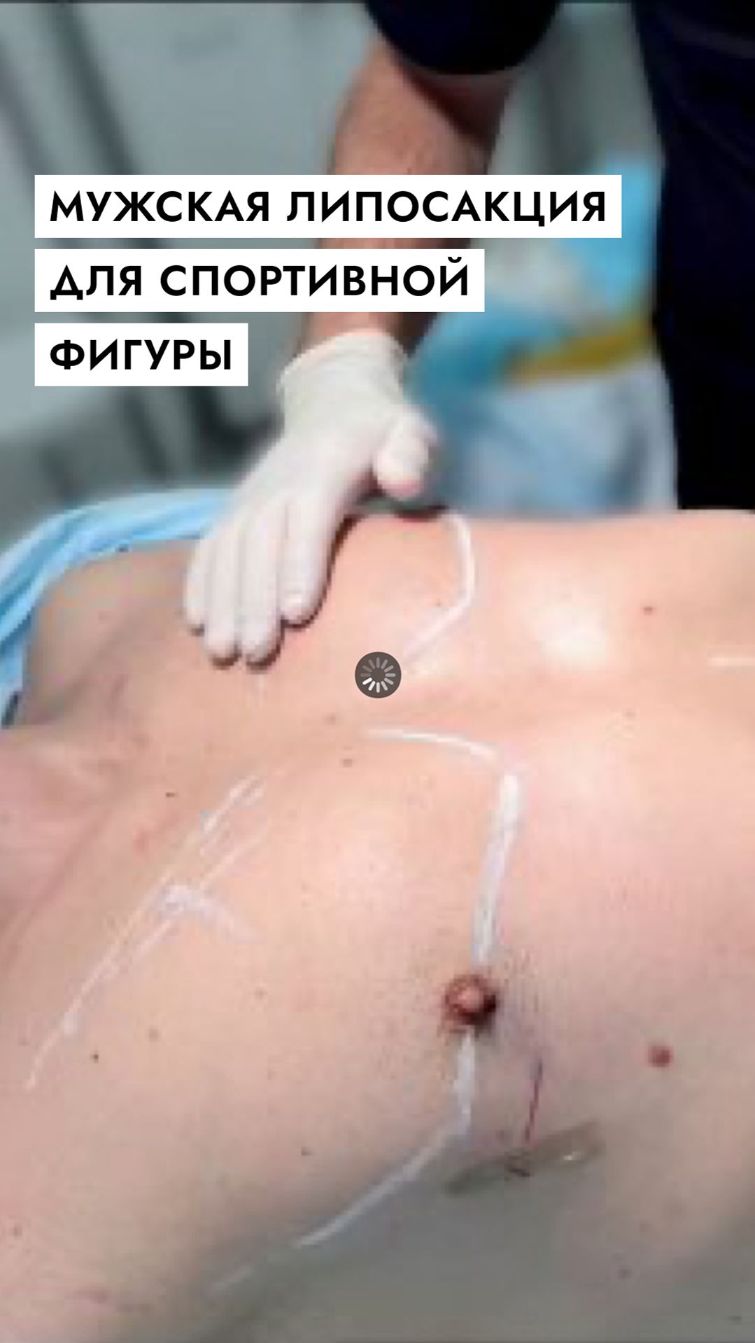 #мужская_липосакция для спортивной фигуры