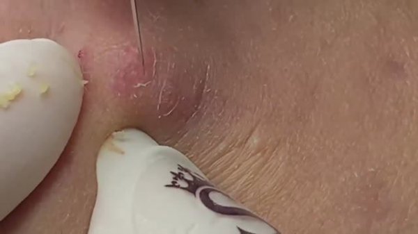 Глубокие закрытые комедоны (подкожные воспаления) - SDS#154