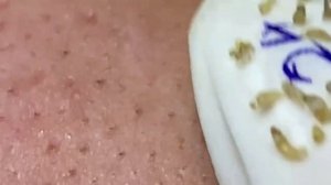 Выдавливание прыщей, угрей, черных точек и камедонов #74