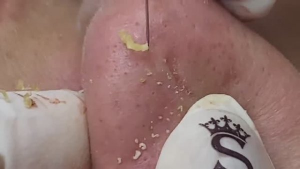 Уродливые прыщи, акне, угри и чёрные точки на носу - SDS#149