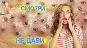 Крупные проблемы . Онлайн выдавливание ОЧЕНЬ СОЧНЫХ ПРЫЩЕЙ. Угри , акне, жировики и комедоны