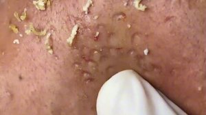 Чистка лица от угрей и акне. Выдавливание прыщей. Удаление черных точек и комедонов