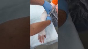 Техника наложения гипсовой лонгеты на предплечье.