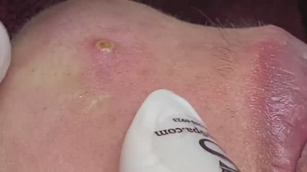 ASMR | Удаление внутренних кистозных прыщей.- SDS#160