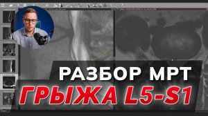 РАЗБОР МРТ: сильная боль от грыжи L5-S1. ЛЕЧЕНИЕ ГРЫЖИ позвоночника без операции
