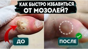 Как нельзя лечить мозоли ❌ и что работает на самом деле