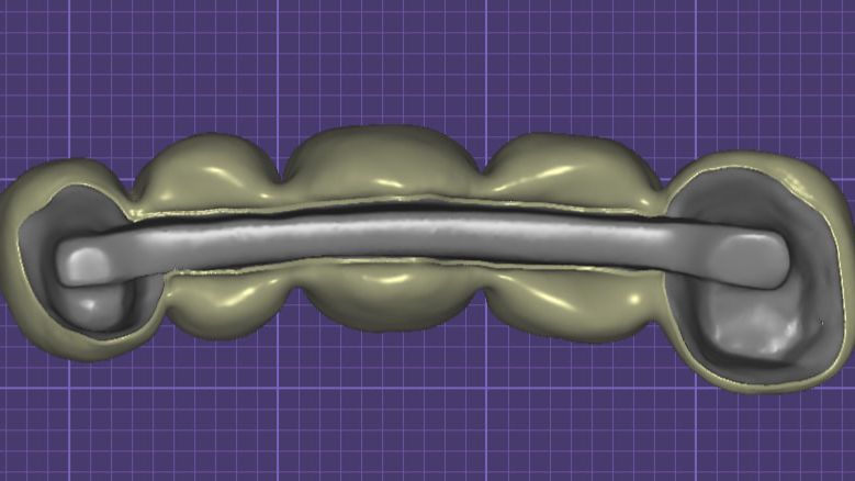 Адаптация ответной части балки на культях смотреть онлайн
