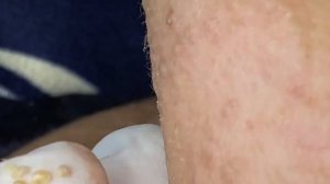 Выдавливание прыщей, угрей, черных точек и камедонов #81