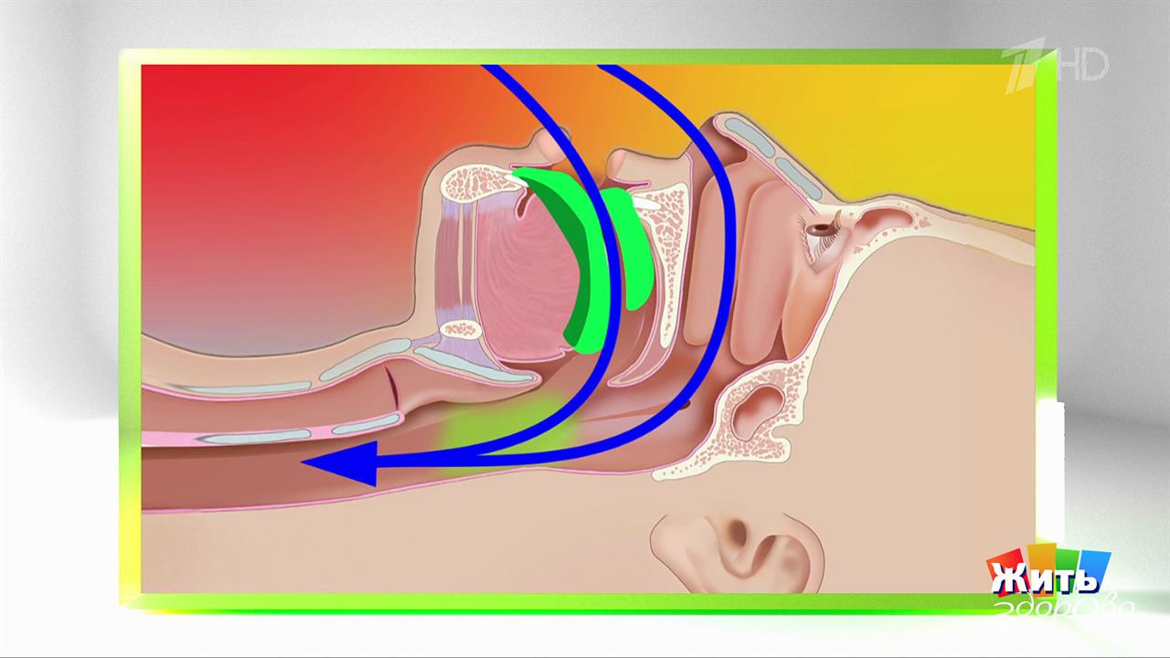 Капы от храпа: чудо или миф? Жить здорово! Фрагмент выпуска от 29.01.2026 смотреть онлайн