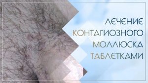👉 Лечение контагиозного моллюска таблетками. Клинический случай №37
