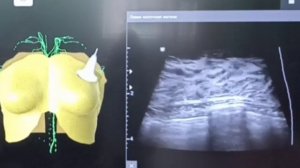 Ретромаммарный мастит