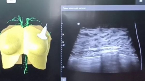 Ретромаммарный мастит