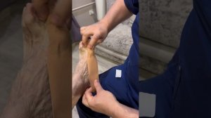 Тейпирование стопы при вальгусной деформации.