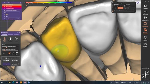 Последовательная дезокклюзия с Artex CR за час смотреть онлайн