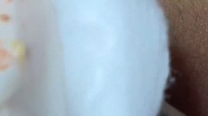 Выдавливание прыщей, угрей, черных точек и камедонов #91