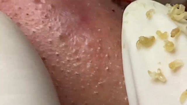 Выдавливание прыщей, угрей, черных точек и камедонов #92 смотреть онлайн