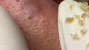 Выдавливание прыщей, угрей, черных точек и камедонов #92