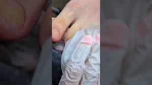 Инструмент, которым сложно поранить клиента В конце можно увидеть динамику отрастания онихолизиса