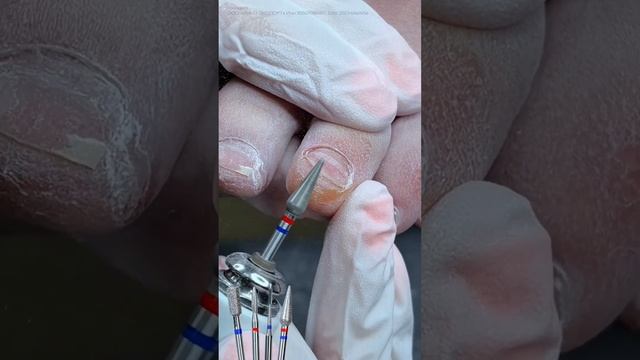 фрезы для полной обработки онихолизиса 💪🏼 третья часть в ленте смотреть онлайн
