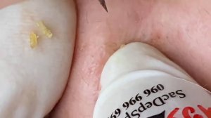 Выдавливание прыщей, угрей, черных точек и камедонов #88