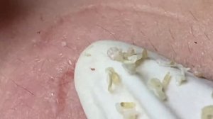 Выдавливание прыщей, угрей, черных точек и камедонов #94