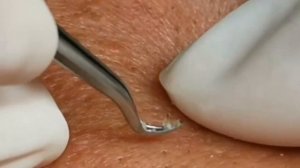 #110 Чистка лица от угрей и акне. Выдавливание прыщей. Удаление черных точек и комедонов