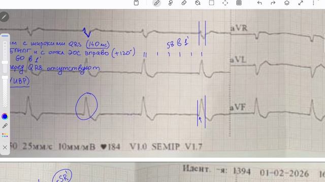 Непонятный ритм, укорочение QT