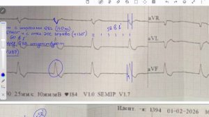 Непонятный ритм, укорочение QT