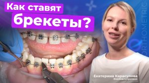 Как устанавливают современные самолигирующие брекеты?