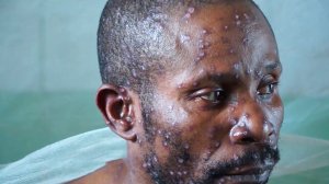 Оспа обезьян уже в России: чем опасна инфекция и возможна ли эпидемия?