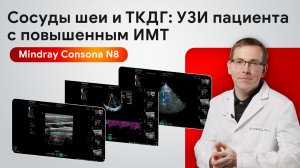 УЗИ сосудов шеи и ТКДГ у пациента с повышенным ИМТ на Mindray Consona N8