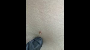 Удаление доброкачественных новообразований кожи электрокоагуляцией