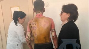 В Красноярске восьмиклассница облила бензином и подожгла одноклассника. У подростка — ожоги 30% тела