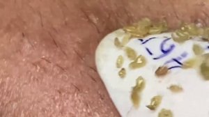 Выдавливание прыщей, угрей, черных точек и камедонов #109