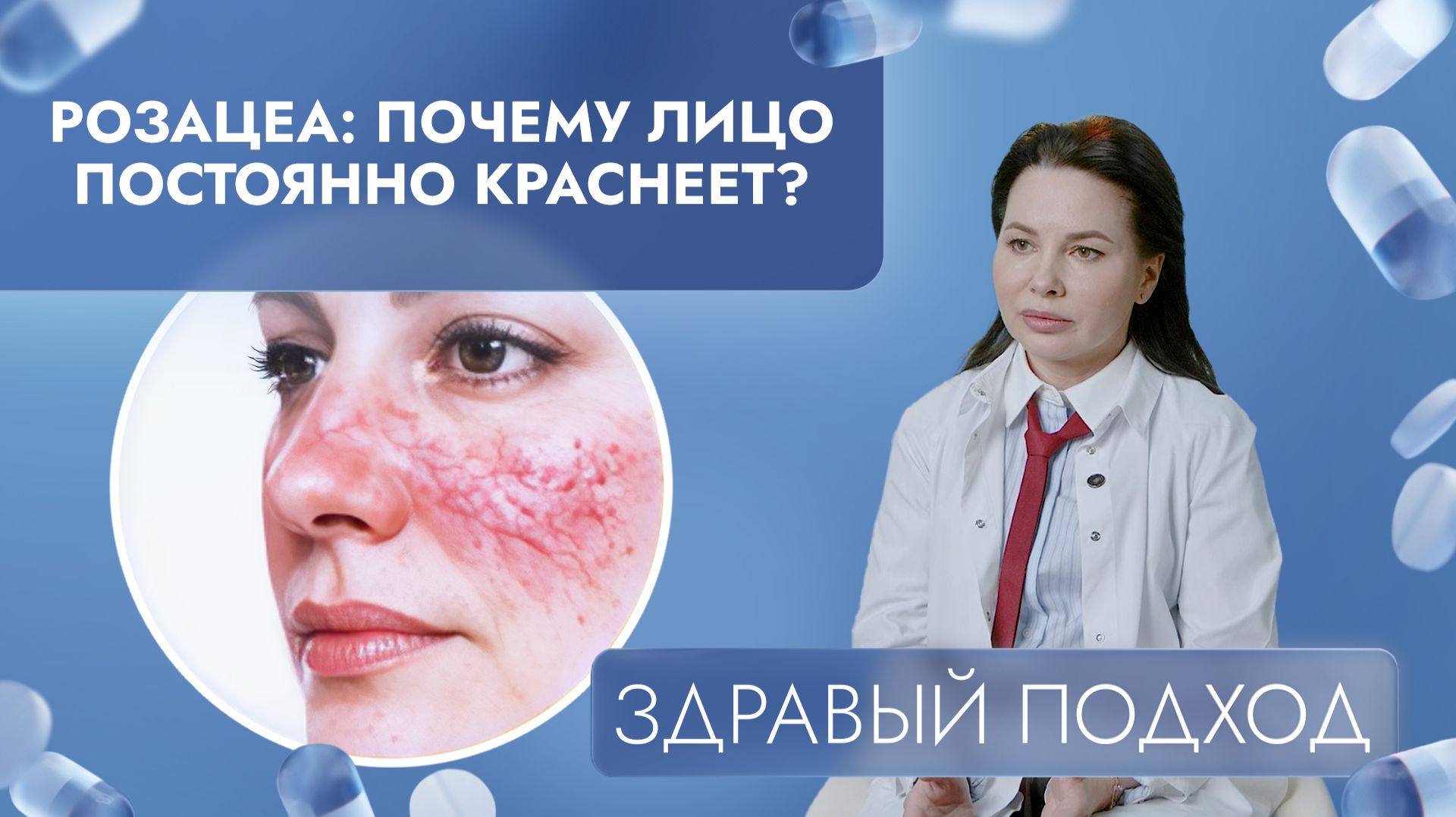 Розацеа: почему лицо постоянно краснеет? | Здравый подход (2026) смотреть онлайн