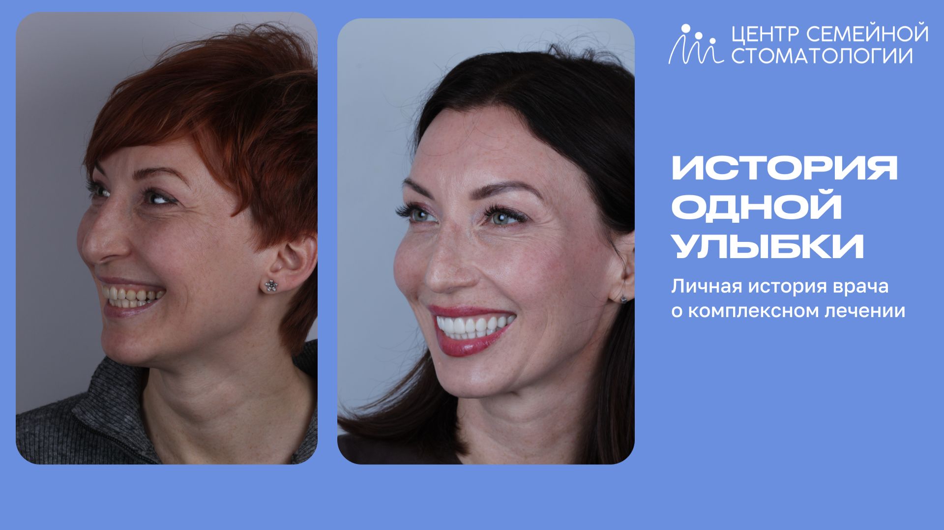 Тотальное преображение улыбки. Виниры и коронки на зубы.