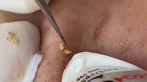 Выдавливание прыщей, угрей, черных точек и камедонов #110