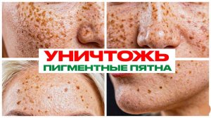 Пигментация уйдет НАВСЕГДА. Самые эффективные методики. Новинки в косметологии